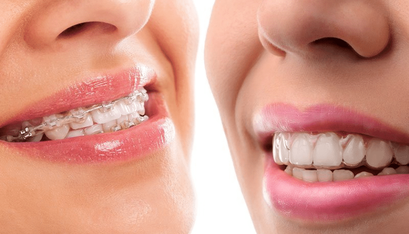 Key Benefits of Choosing Invisalign Over Metal Braces
