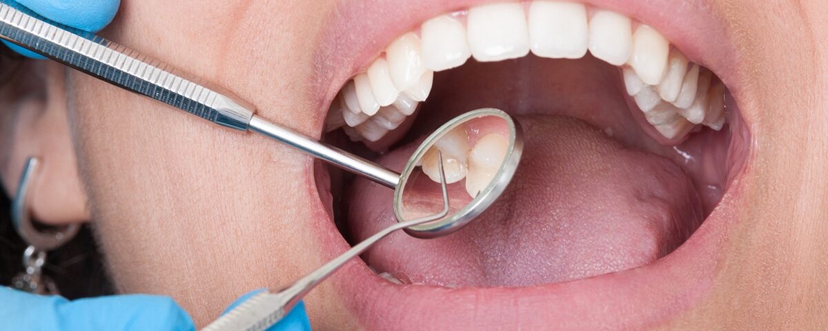 How Sherway Trillium Dental Handles Emergency Tooth Extractions & Repairs