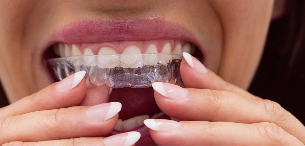 Why Etobicoke Residents Prefer Invisalign Over Traditional Braces