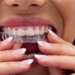 Why Etobicoke Residents Prefer Invisalign Over Traditional Braces