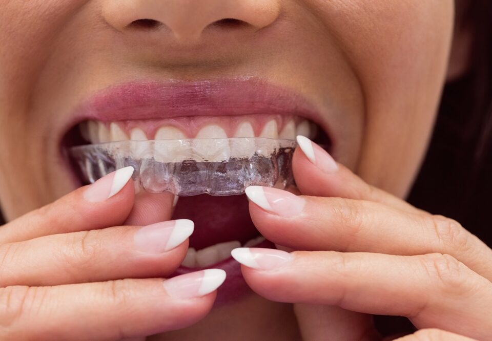 Why Etobicoke Residents Prefer Invisalign Over Traditional Braces